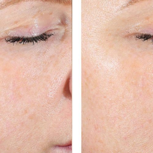 Skinbetter AlphaRet Exfoliating Pads before and after2